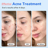 Pack of 165 round hydrocolloid acne pimple patches for face, shown in packaging with salicylic acid formula - view 5
